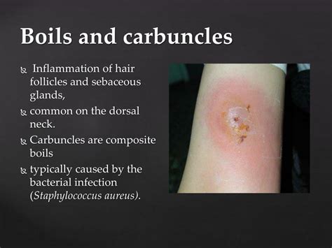 Boils and carbuncles .